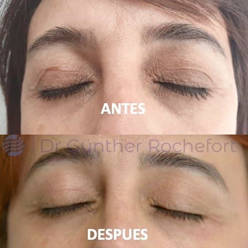 Blefaroplastia_antes_y_después