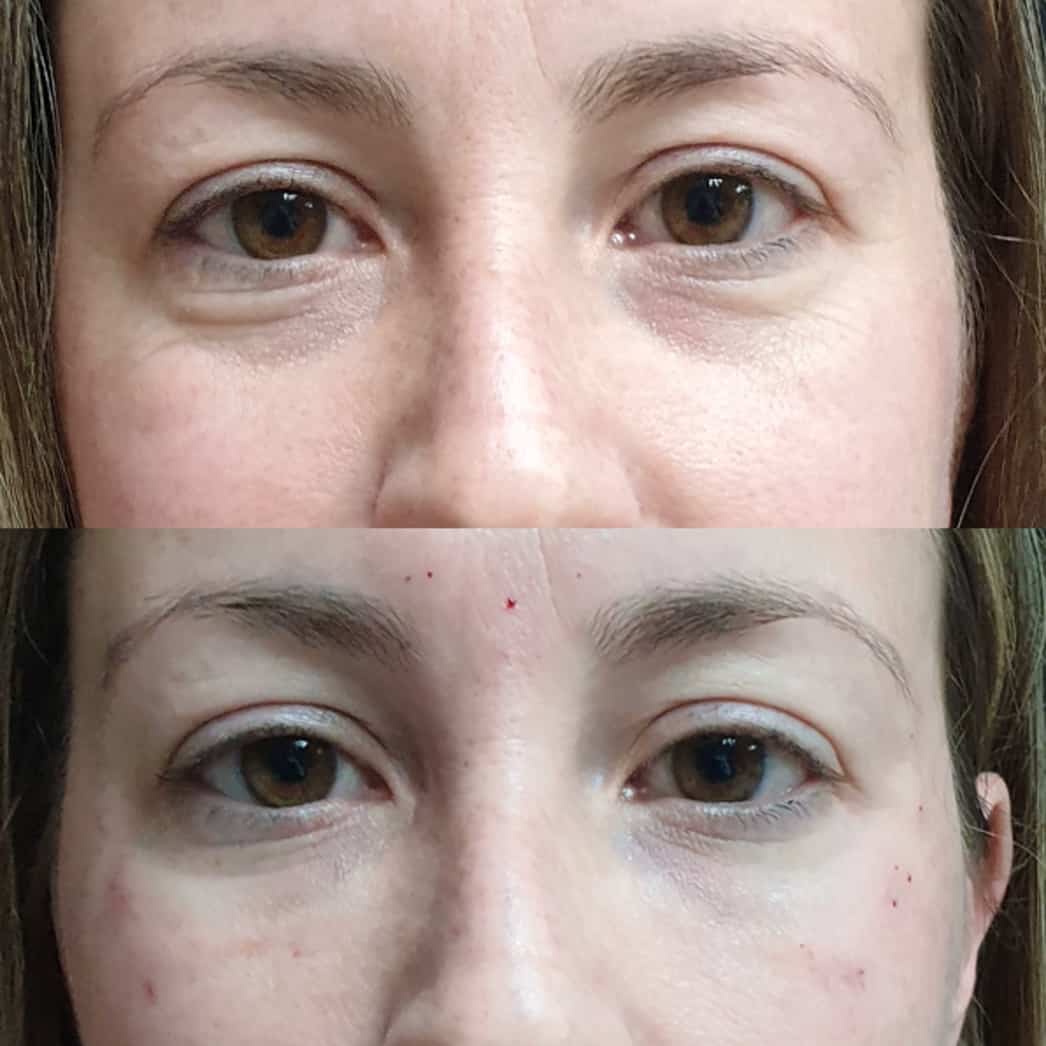 Blefaroplastia antes y despues