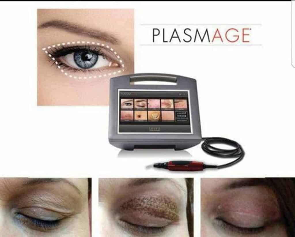 plasmage proceso blefaroplastia