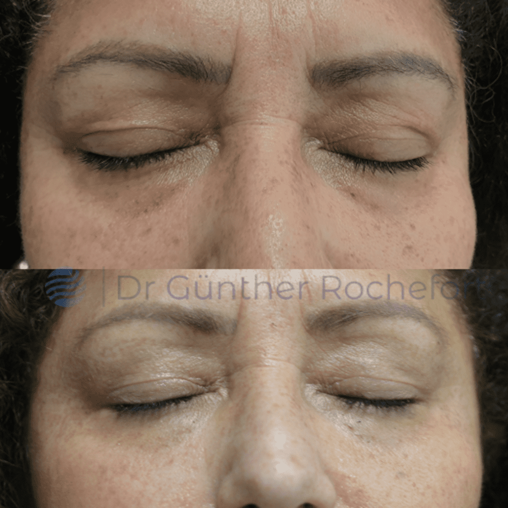 Blefaroplastia laser