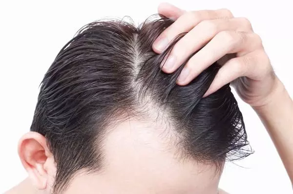 tratamiento_alopecia