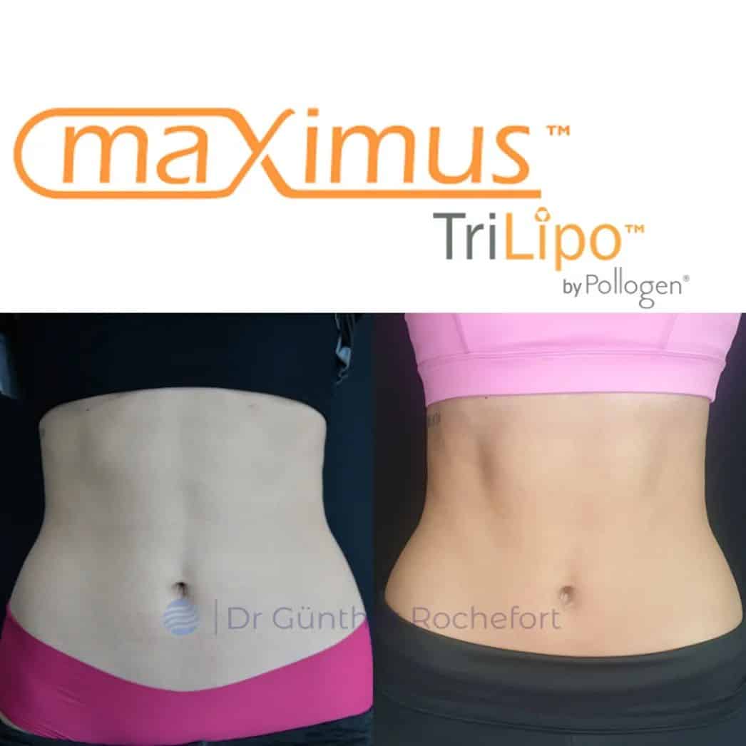 Maximus Trilipo Reduccion Abdomen frontal